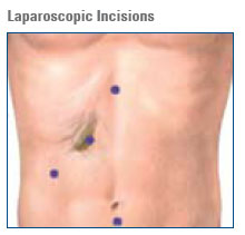 laparoscopic incisions