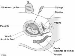 Aminocentesis Aminocentesis