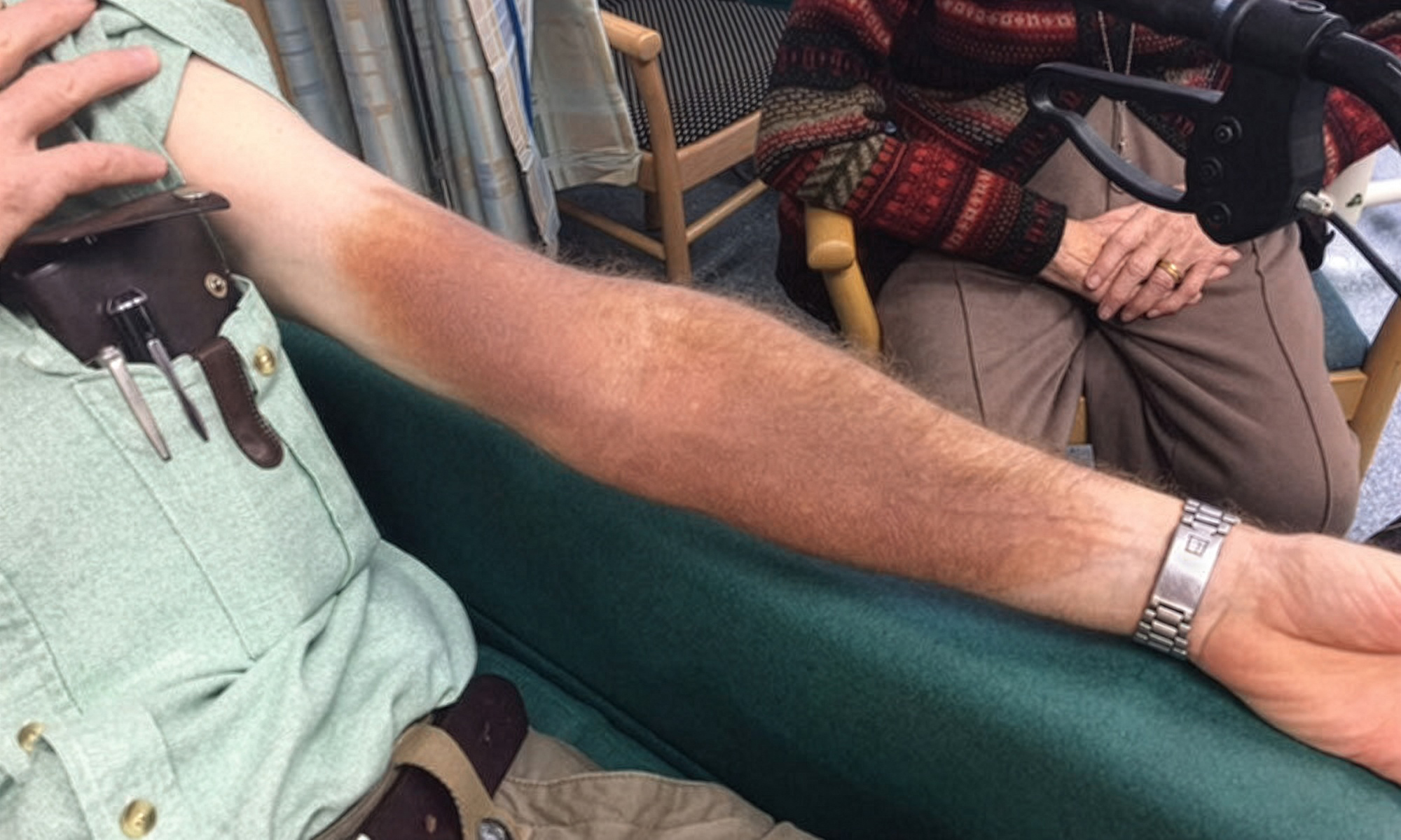 Example of skin staining