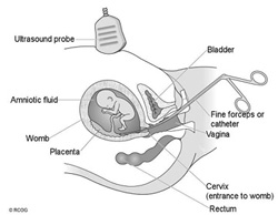 Transcervical CVS Transcervical CVS