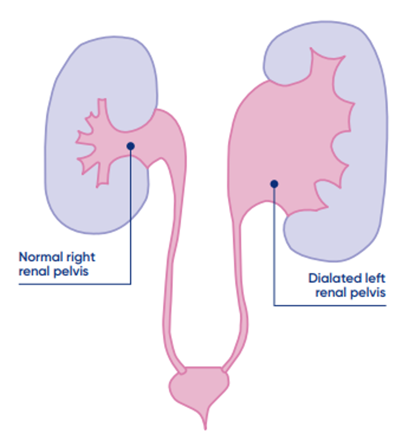 Kidney pelvis dilatation