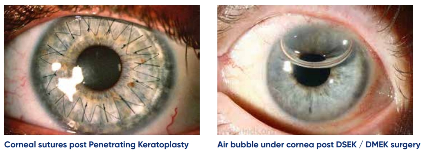 Image sources - https://keratoconusgb.com/what-is-a-corneal-graft-or-transplant/ and https://eyerounds.org/tutorials/Cornea-Transplant-Intro/5-DMEK.htm