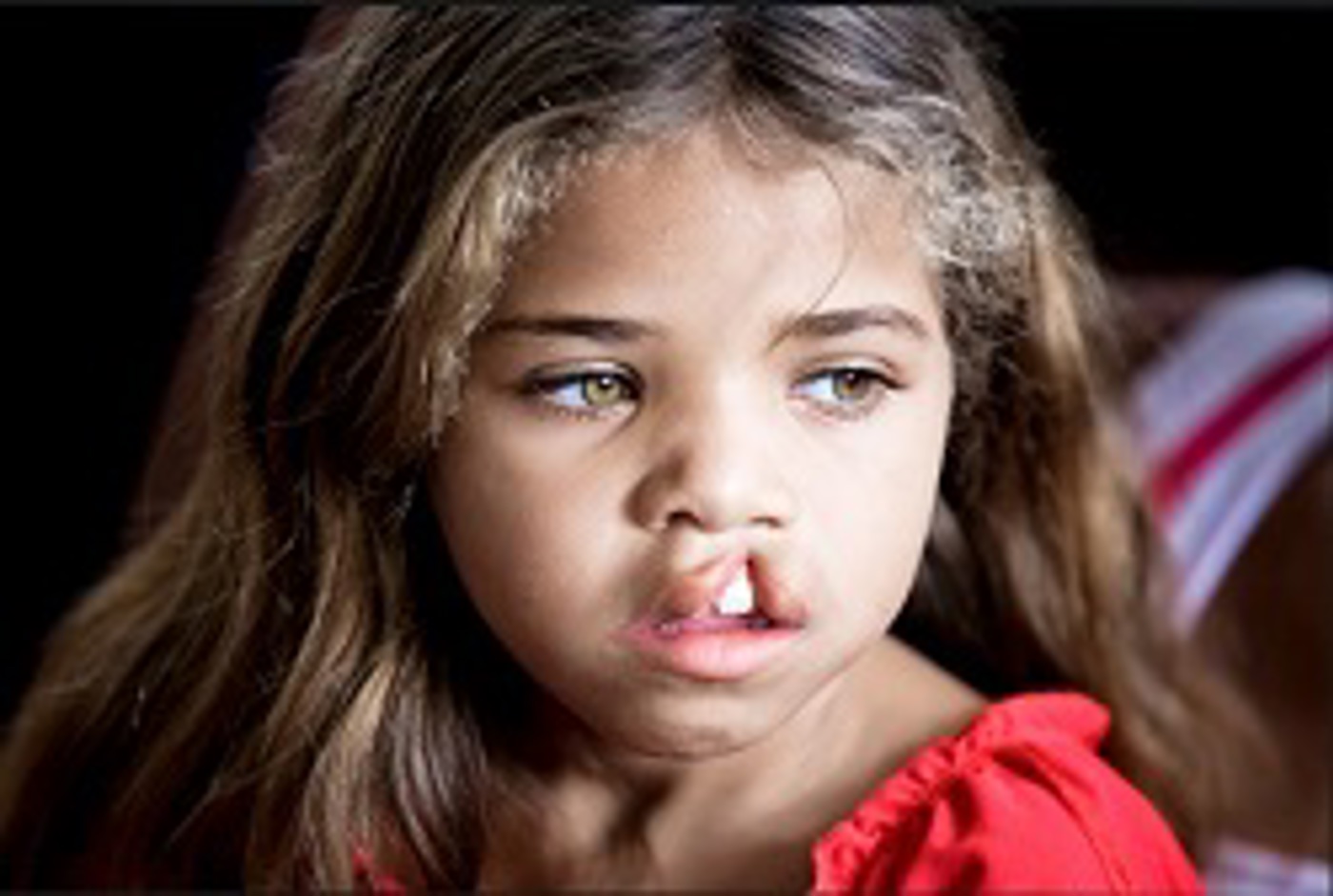 Danila, patient Brazil, before