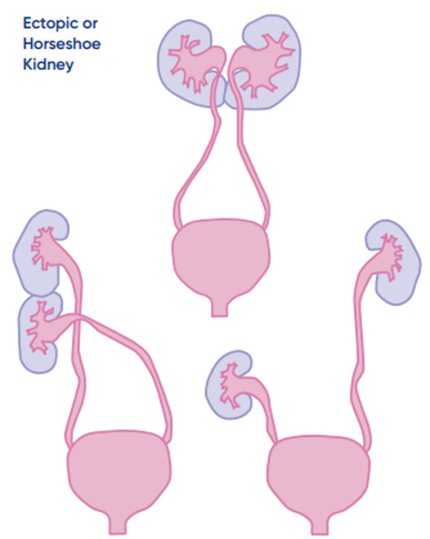 Kidney pelvis dilatation